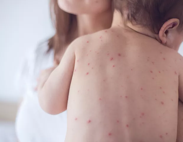 Nova York decreta emergência por surto de sarampo