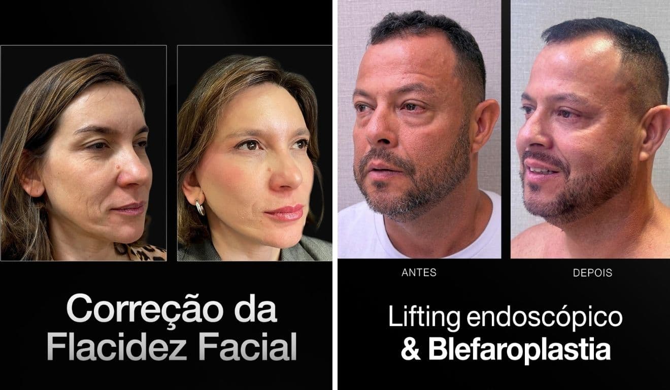 Menos cortes e alta no mesmo dia? Veja como funciona o lifting facial endoscópico