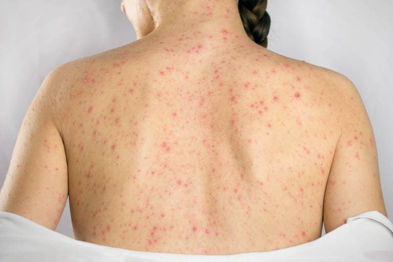 Eletroacupuntura pode ajudar a aliviar dor persistente após herpes-zóster
