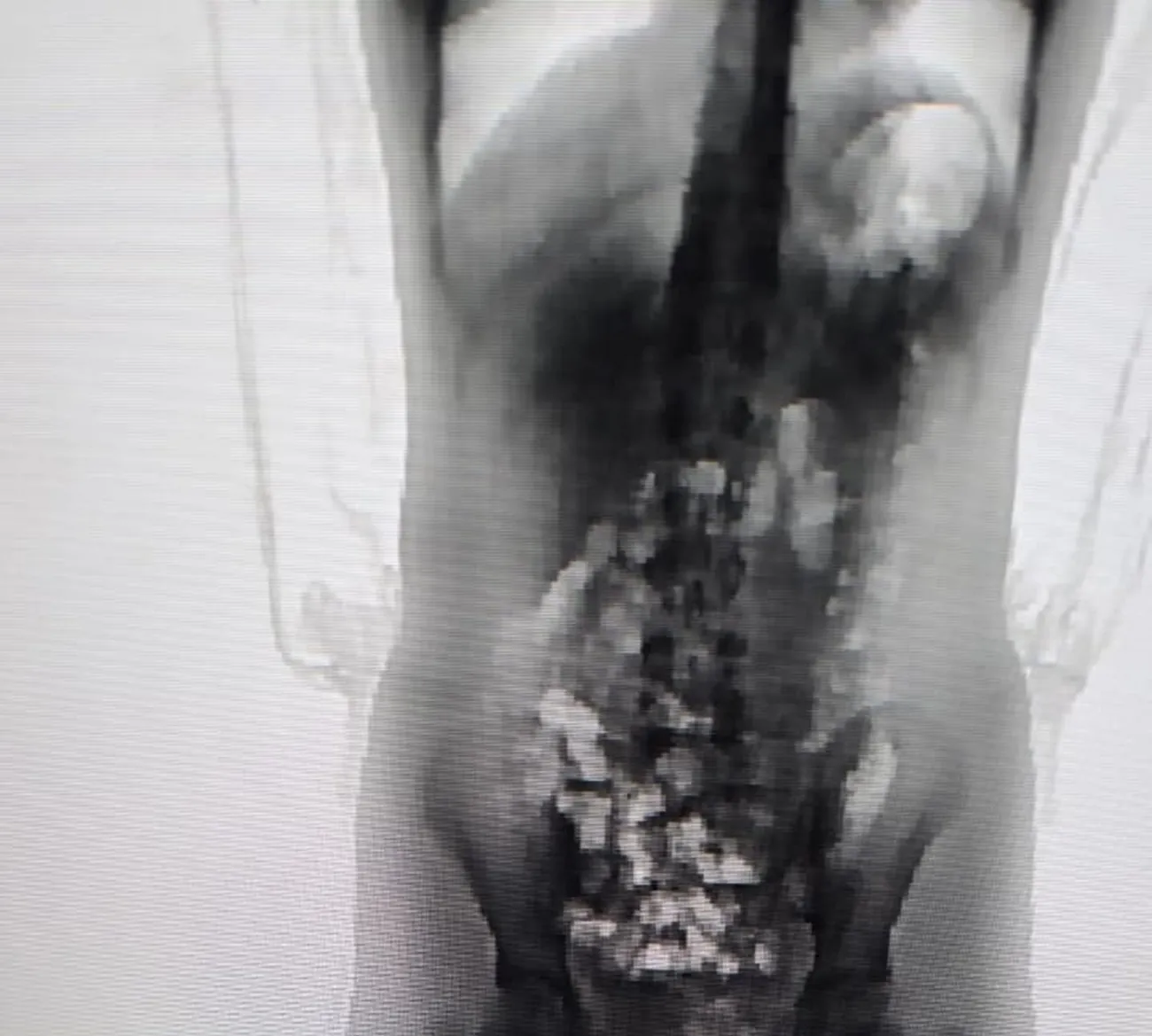 Scanner corporal flagra adolescente de 13 anos com droga dentro do corpo em presídio de Chapecó