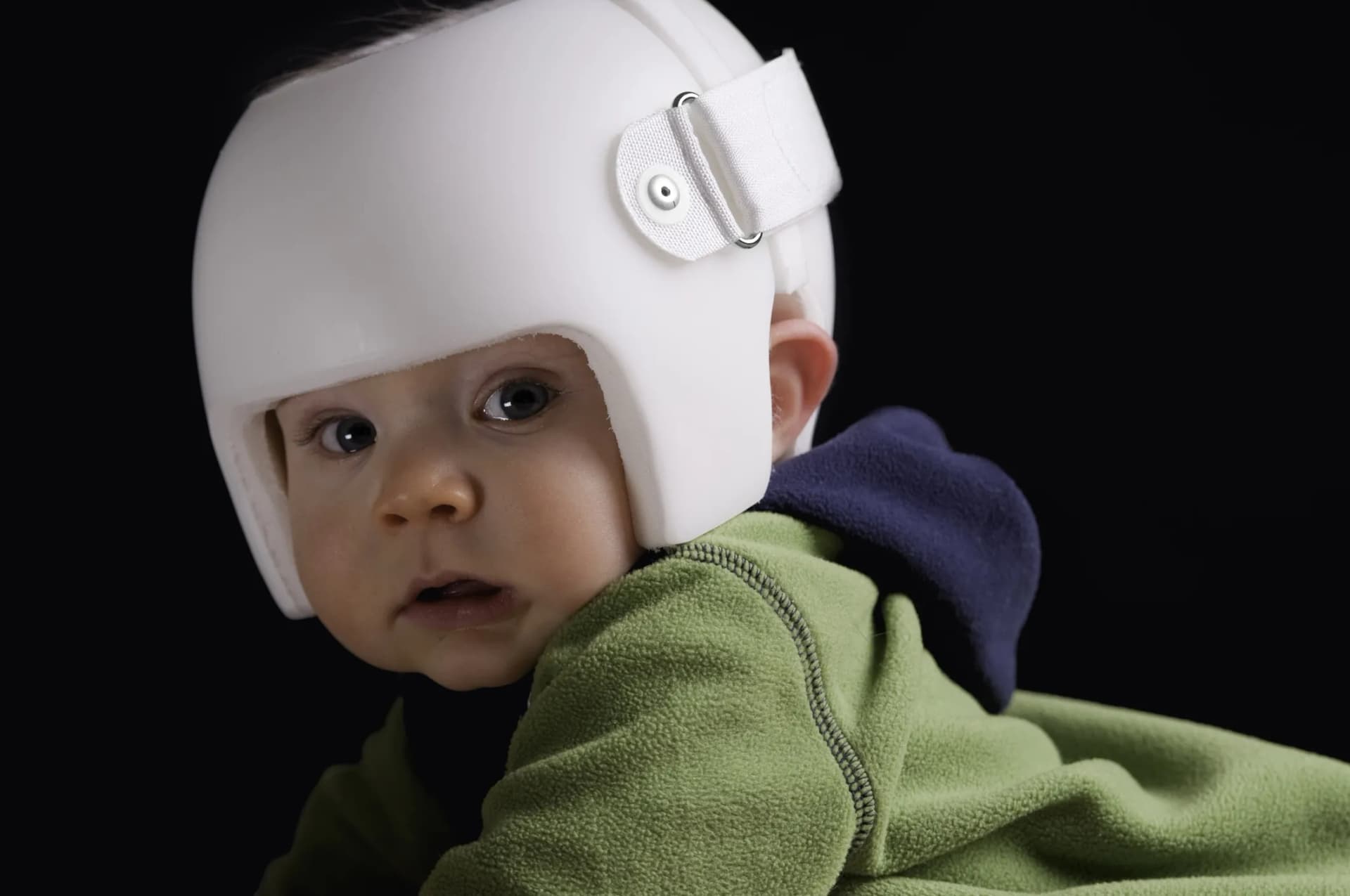 Capacete para corrigir cabeça do bebê deve ser exceção, não regra